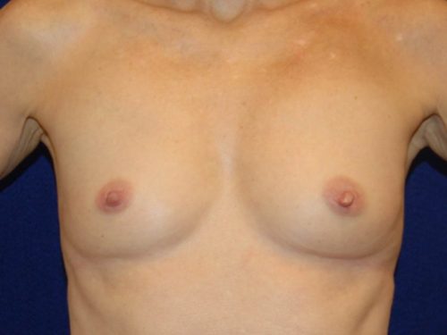 Breast Augmentation before and after - before