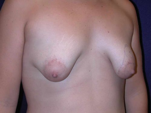 Procedure before and after - before