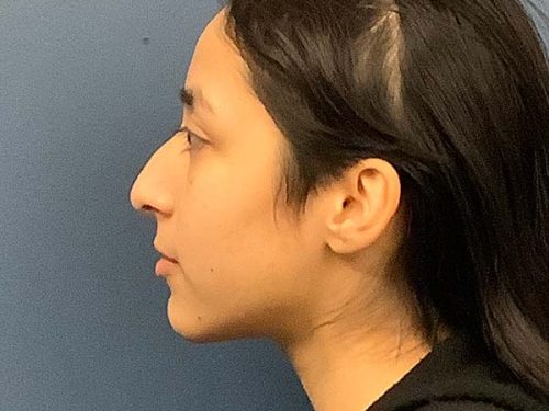 Rhinoplasty before and after - before