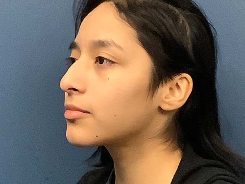 Rhinoplasty before and after - before