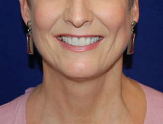 Facelift before and after - before