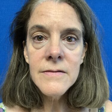 Facelift before and after - before