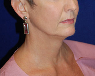 Facelift before and after - before