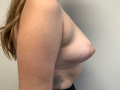 Breast Augmentation before and after - before