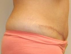 Mommy Makeover before and after - after