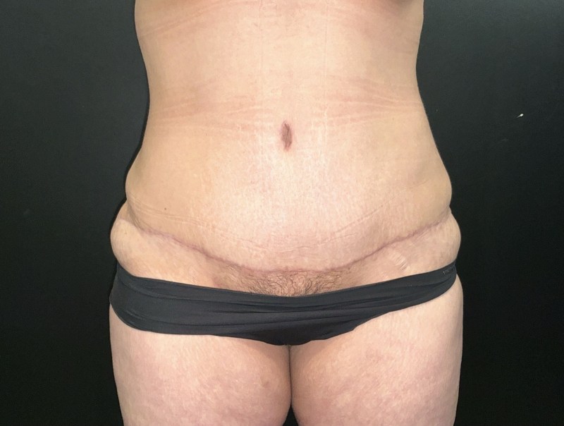 Mommy Makeover before and after - after