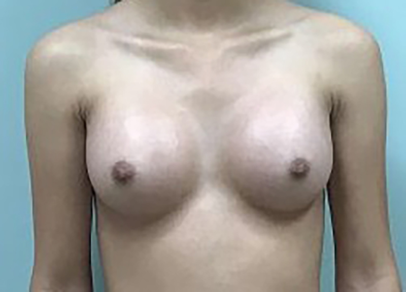 Breast Augmentation before and after - after