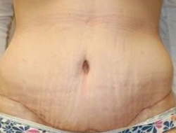 Mommy Makeover before and after - after