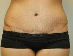Mommy Makeover before and after - after