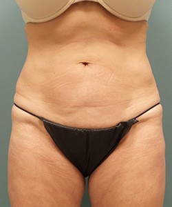 Mommy Makeover before and after - after