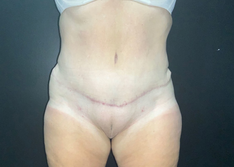 Mommy Makeover before and after - after
