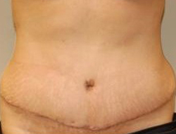 Mommy Makeover before and after - after