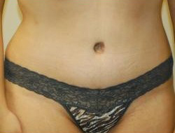 Mommy Makeover before and after - after