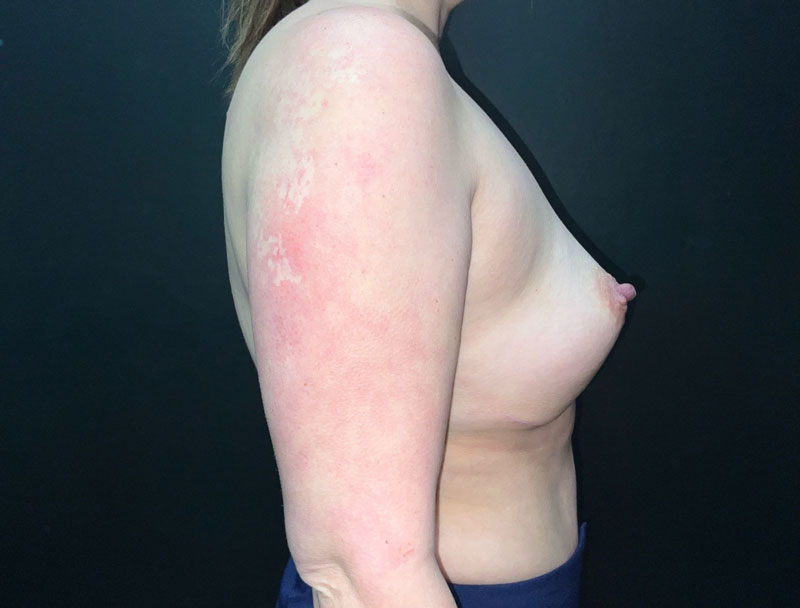 Breast Augmentation before and after - after
