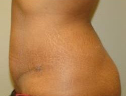 Mommy Makeover before and after - after