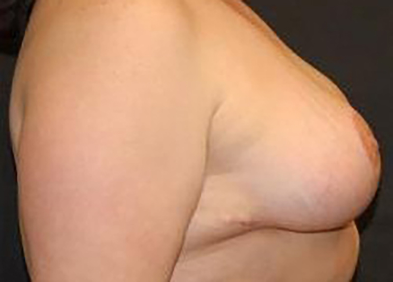 Breast Reduction before and after - after