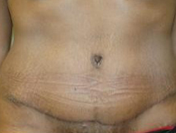 Mommy Makeover before and after - after