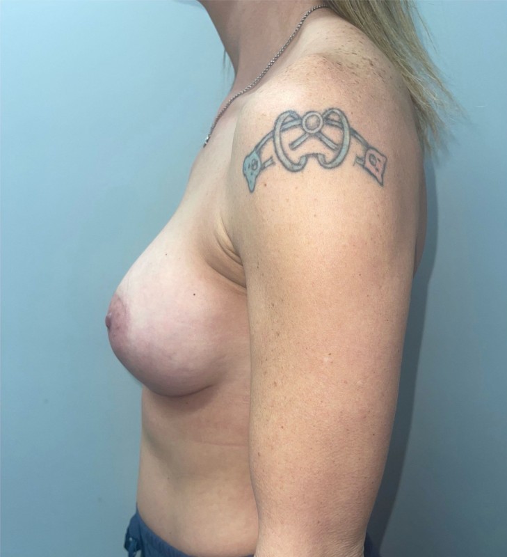 Breast Augmentation before and after - after