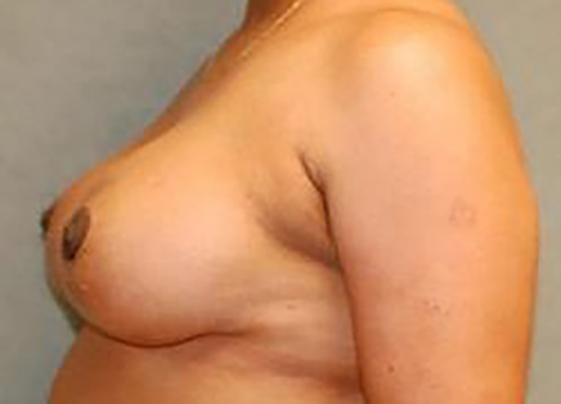 Breast Reduction before and after - after