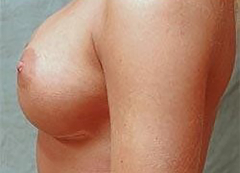 Breast Augmentation before and after - after