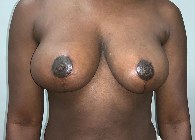 Breast Reduction before and after - after