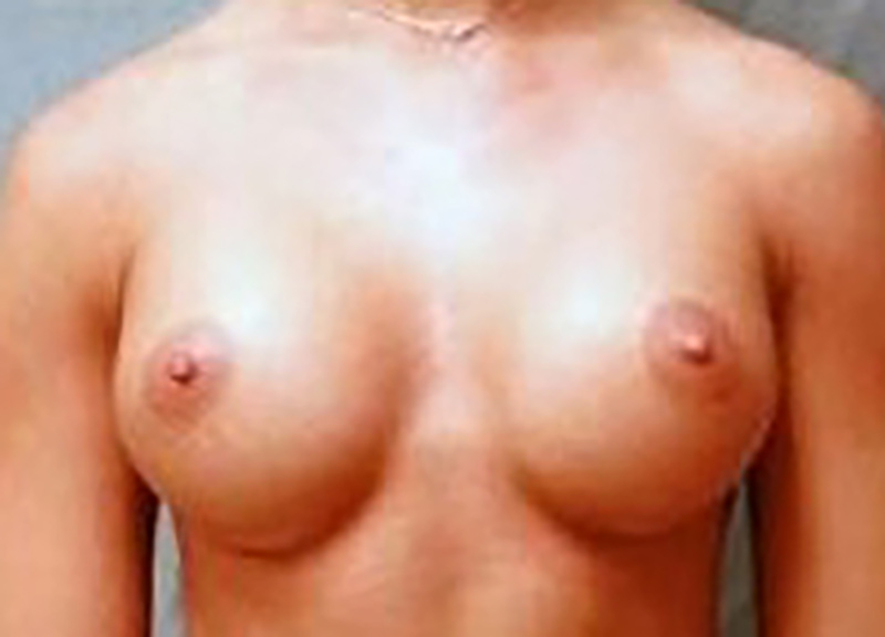 Breast Augmentation before and after - after