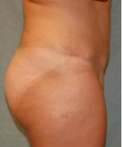 Mommy Makeover before and after - after