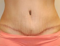 Mommy Makeover before and after - after