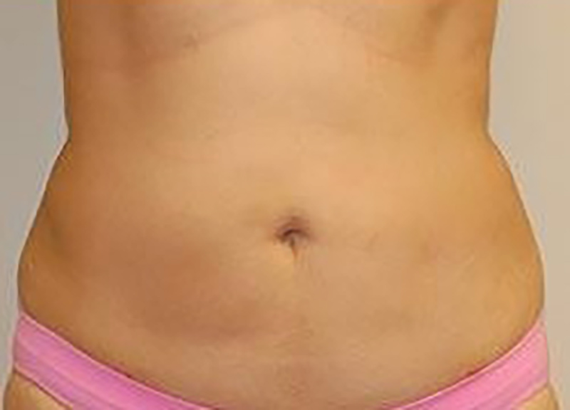 Liposuction before and after - after