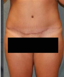 Mommy Makeover before and after - after