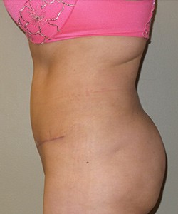 Mommy Makeover before and after - after