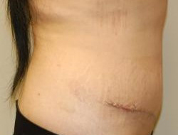 Mommy Makeover before and after - after