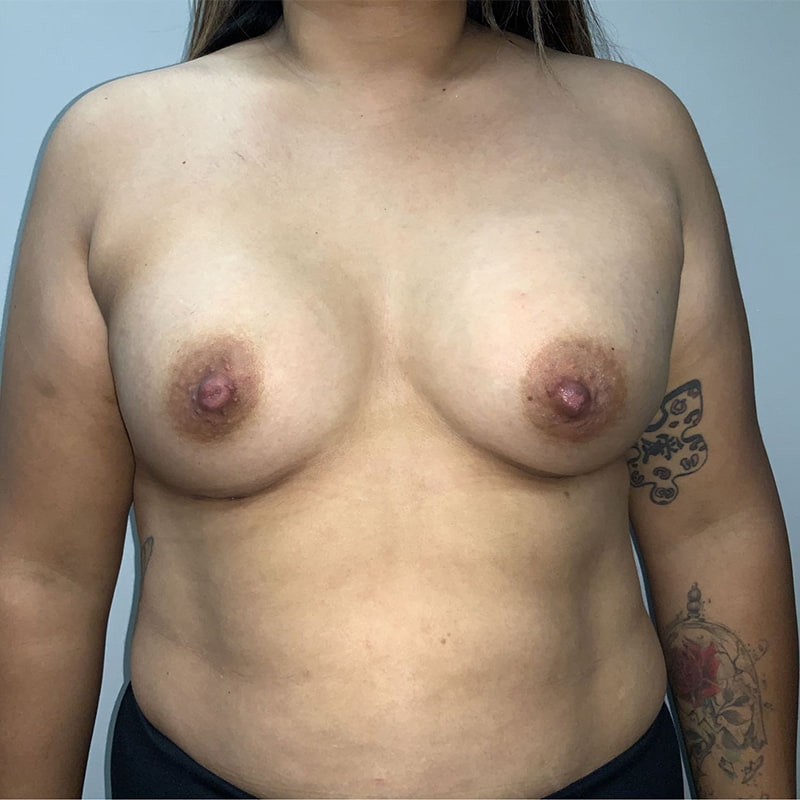 Breast Augmentation before and after - after