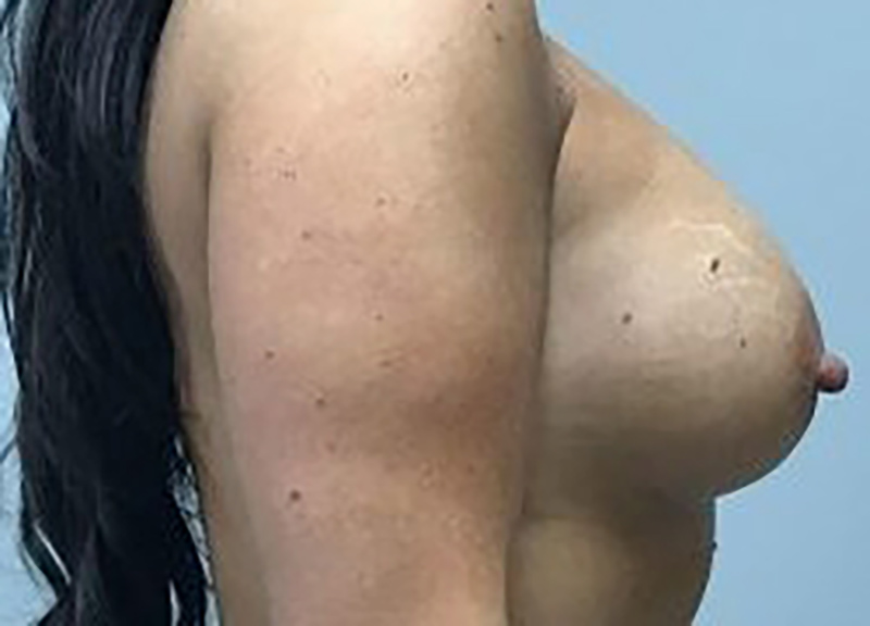Breast Augmentation before and after - after