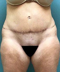 Mommy Makeover before and after - after