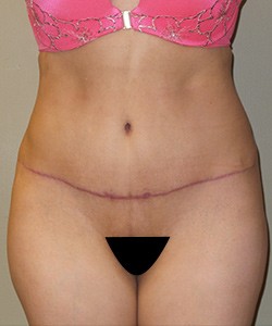 Mommy Makeover before and after - after