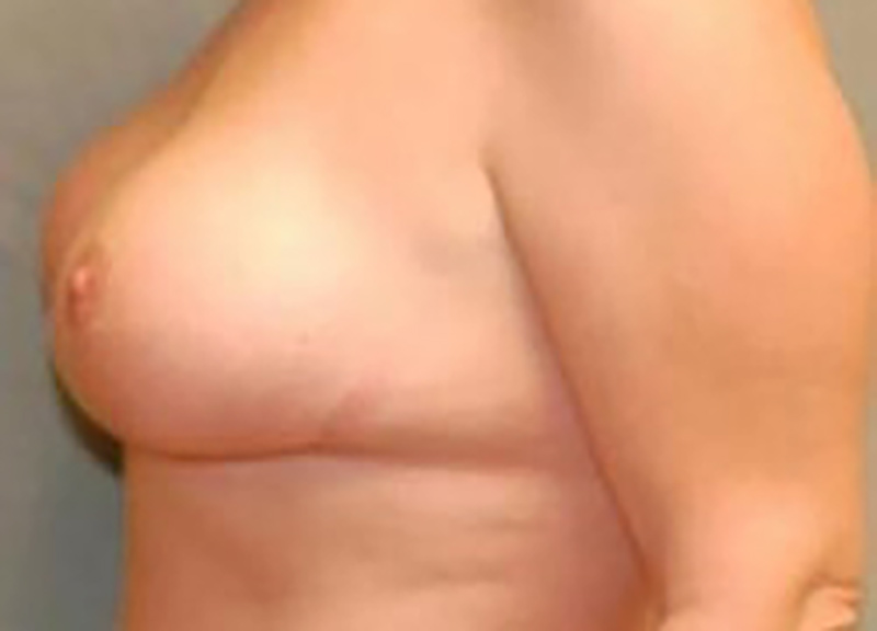 Breast Lift before and after - after