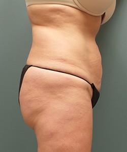 Mommy Makeover before and after - after