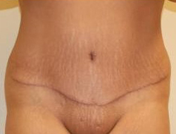 Mommy Makeover before and after - after