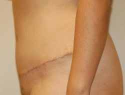 Mommy Makeover before and after - after