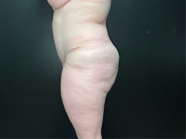Mommy Makeover before and after - after