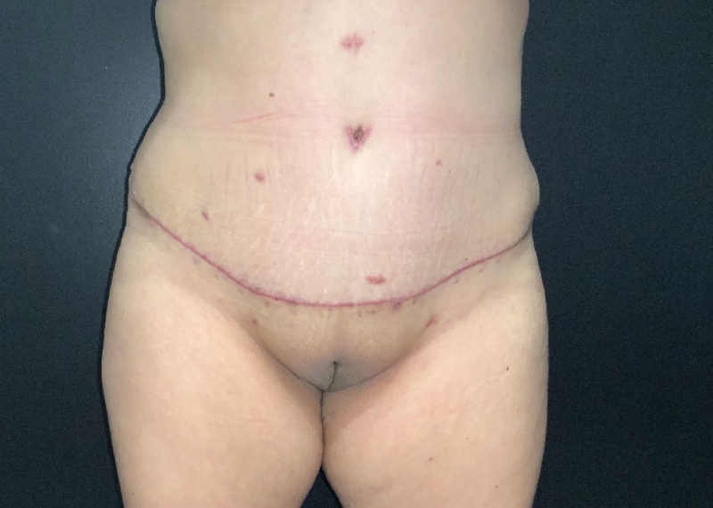 Mommy Makeover before and after - after