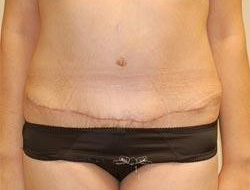 Mommy Makeover before and after - after
