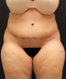 Mommy Makeover before and after - after