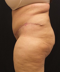 Mommy Makeover before and after - after