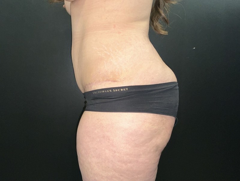 Mommy Makeover before and after - after
