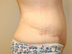 Mommy Makeover before and after - after