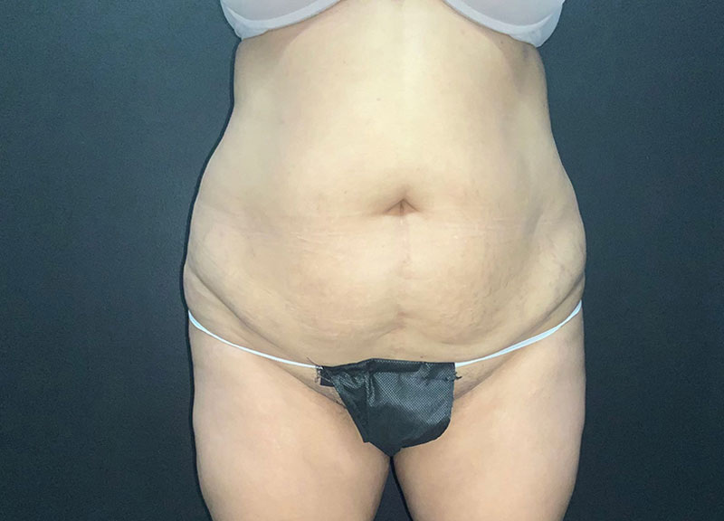 Liposuction before and after - before