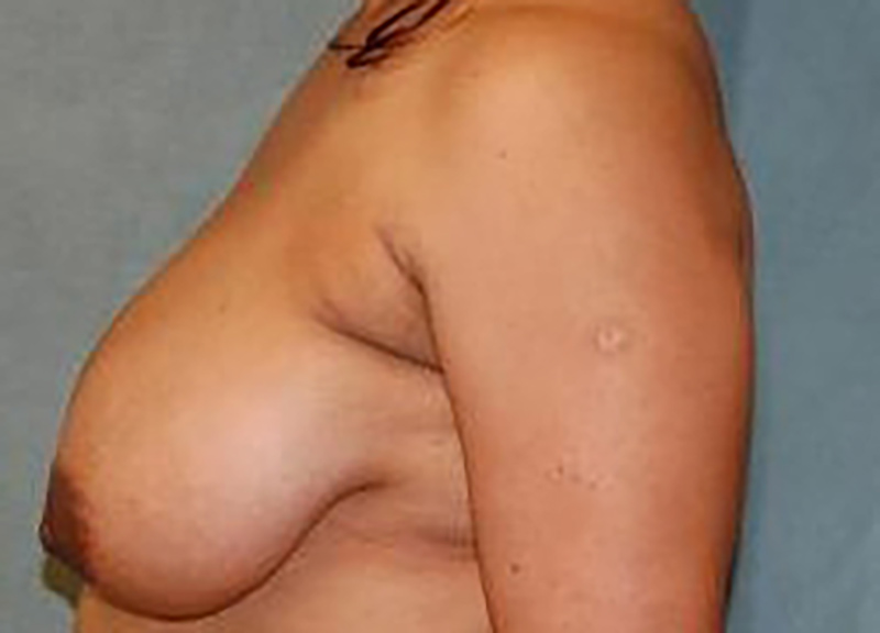 Breast Reduction before and after - before
