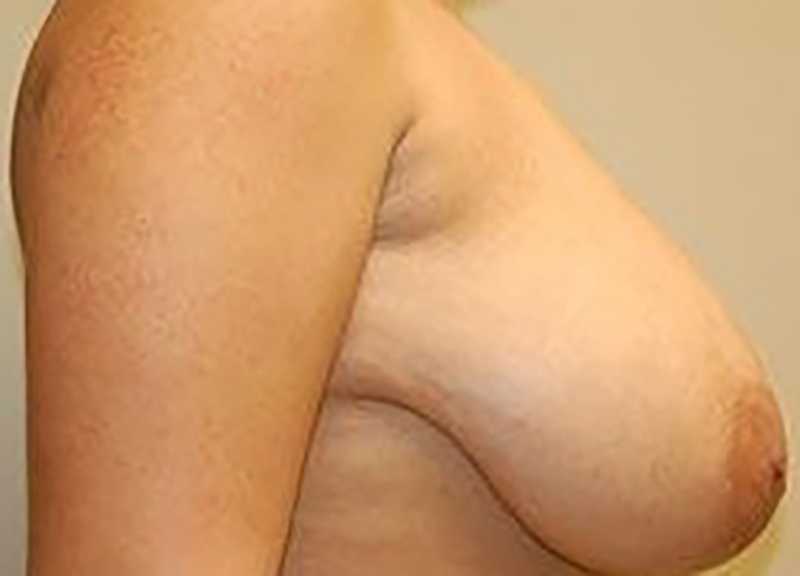 Breast Reduction before and after - before